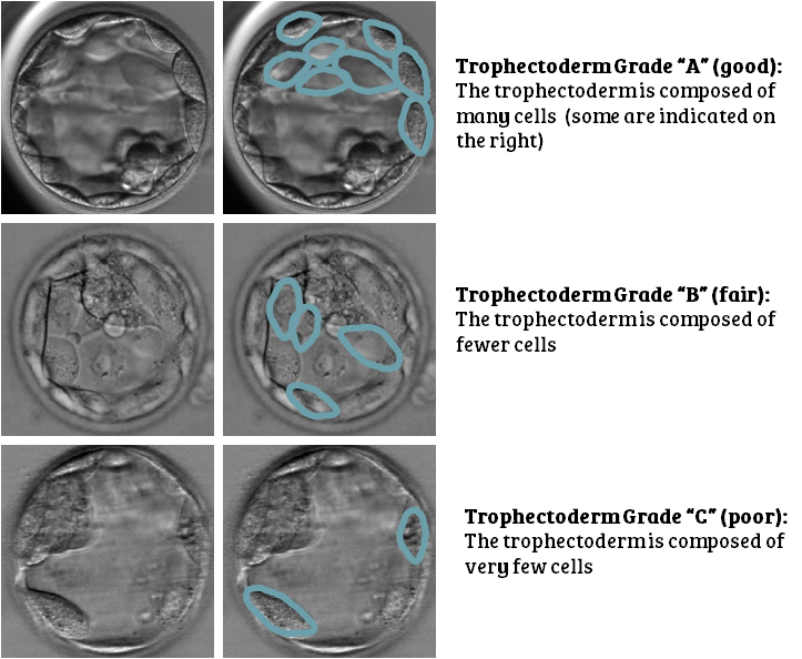 Day 5 embryo grading: trophectoderm grade