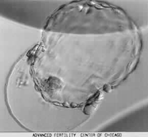 Hatching 5AA blastocyst