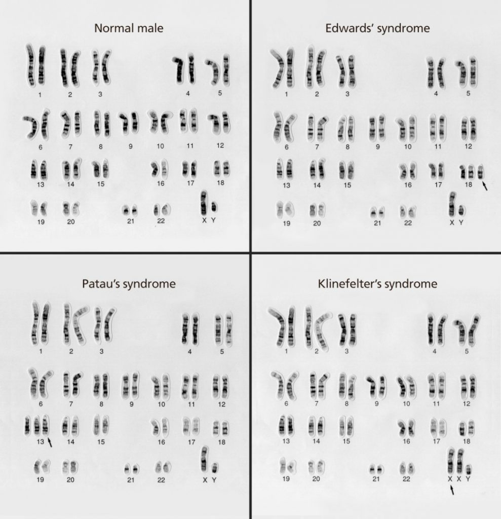 Karyotypes with different numerical abnormalities